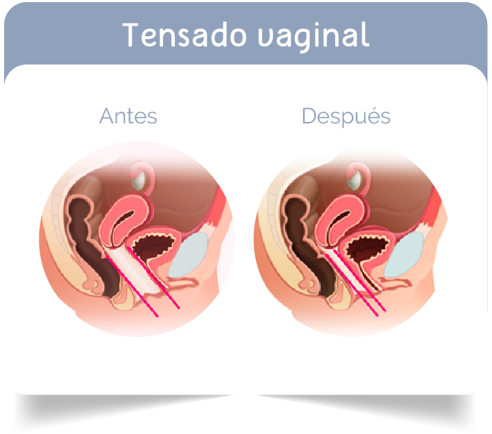 Tensado Vaginal Bogota