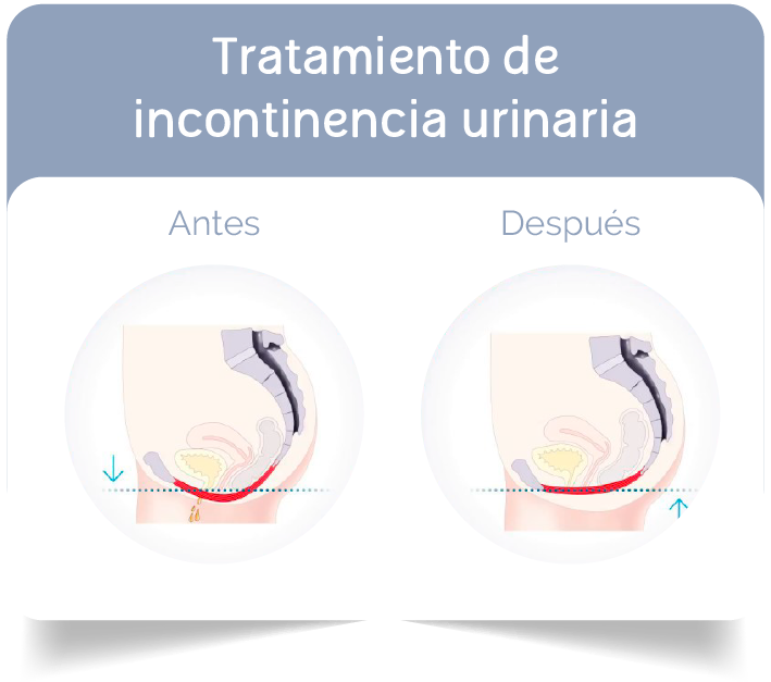 Tratamiento Incontinencia Urinaria Bogota